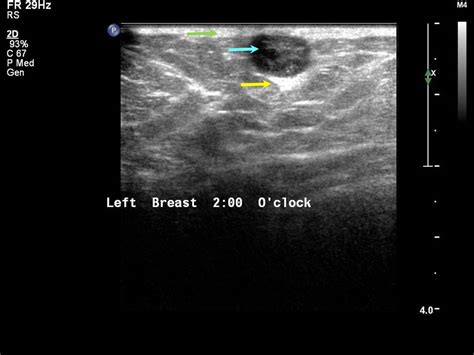 Atlas Of Breast Cancer Early Detection