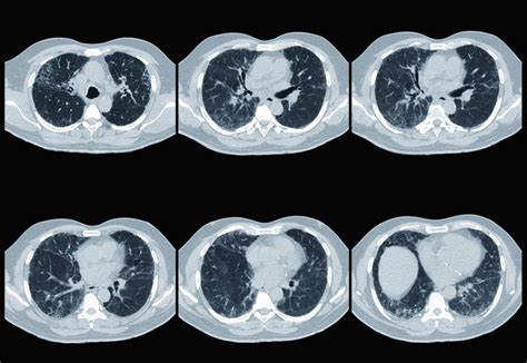 Interstitial Lung Abnormalities Linked To Clinical Course In Copd
