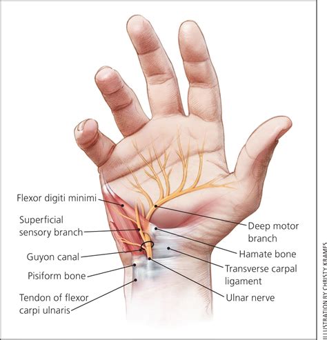 Evaluation And Diagnosis Of Wrist Pain A Case Based Approach Aafp