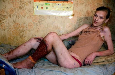 Flesh Eating Drug Krokodil Has Hit The Uk Leaving Addicts With Rancid Rotting Flesh Open Pus