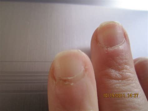 Nail Fold Abnormalities Scleroderma