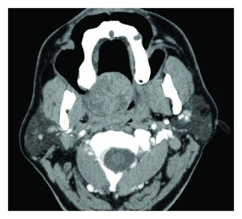 A Axial And B Sagittal Contrast Enhanced Ct Scan Demonstrated A