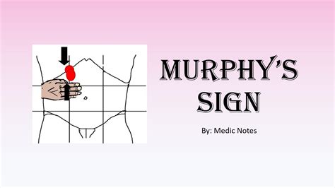 Murphys Sign Pathophysiology Youtube