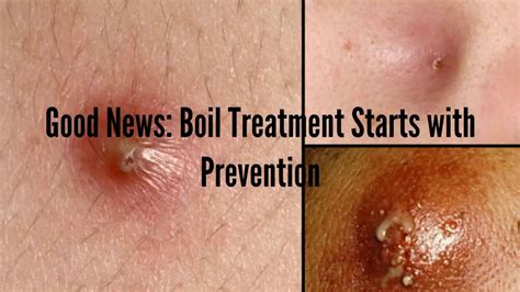 The Big Ways To Prevent Boils Boil Treatment Begins With Prevention