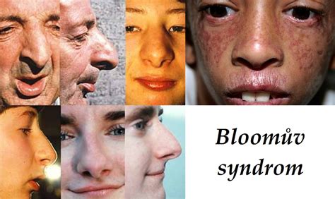 Bloomův Syndrom Příznaky Projevy Symptomy Příčina Léčba