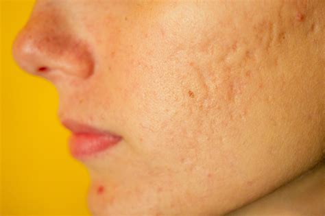 Move On From The Teen Years Is It Possible To Get Rid Of Acne Scars