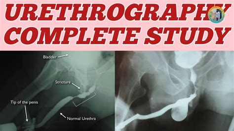 Retrograde Urethrogram Complete Study Youtube