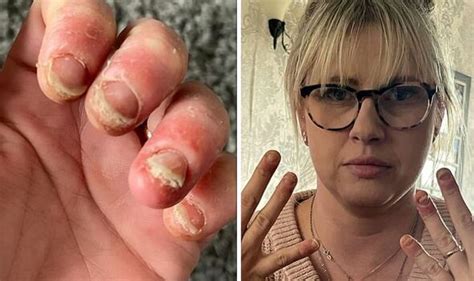 Young Mum Feared She Could ‘lose A Finger After Terrifying Reaction To Manicure ⋆ Latest News