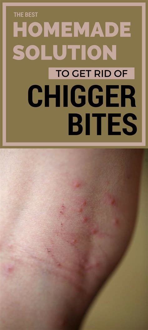 List Of How To Get Rid Of Chiggers In My House References