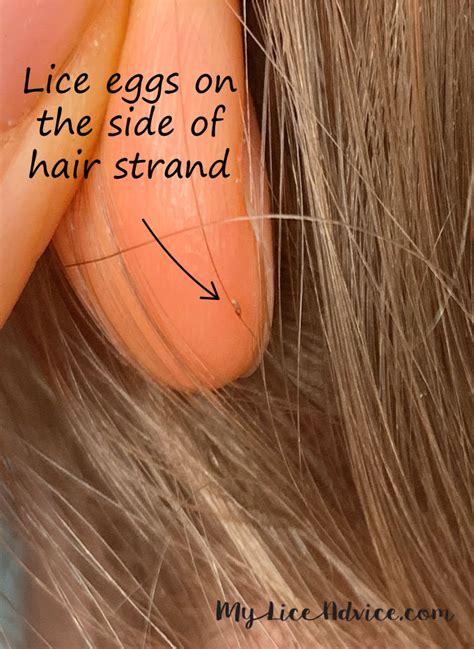 Pictures Of What Lice Eggs Nits Look Like In Hair 9 Tips To Spot Them