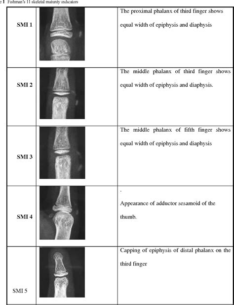 Digital Radiographic Evaluation Of Hand Wrist Bone Maturation And