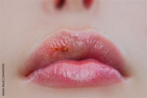 Pictures Of Lips Diseases