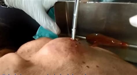Draining A Huge Bump On The Back New Pimple Popping Videos