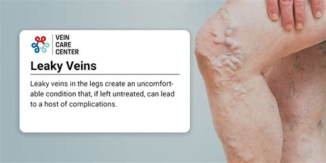 Treatment For Leaky Veins Nyc Vein Care Center