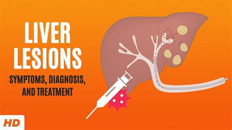 Liver Lesions Symptoms Diagnosis And Treatment Youtube