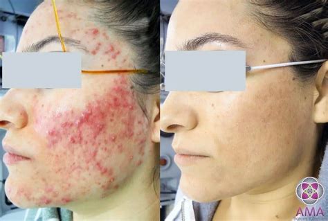Laser Acne Treatment To Eliminate Cystic Acne