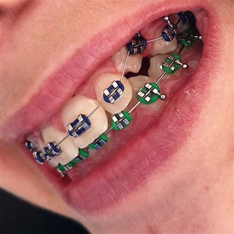 Braces Colors Which One Is Best For You Braces Explained