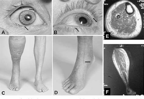 Figure 1 From Lymphedema Distichiasis Syndrome Without Foxc2 Mutation