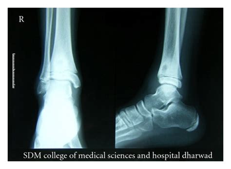 X Ray Of Right Ankle Joint Showing Submetaphyseal Osteolytic Lesion