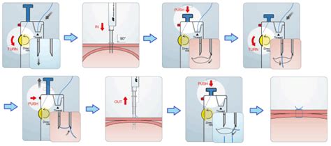 A Comparative Randomized Trial With 20 Fr Pulls And 20 Fr Push