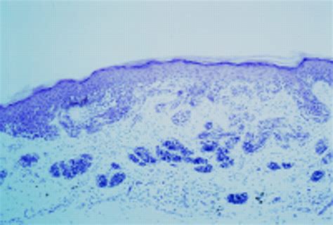 Small Cell Malignant Melanoma A Variant Of Naevoid Melanoma