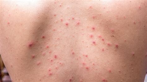 How To Prevent And Treat 8 Common Skin Conditions Everyday Health