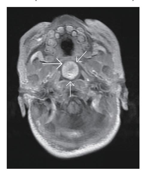Figure From Nasopharyngeal Teratoma In A Neonate Semantic Scholar