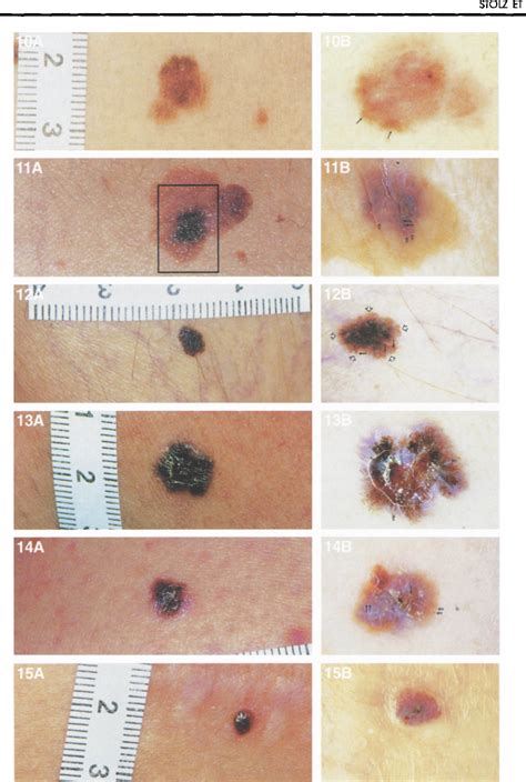 Figure 10 15 From Principles Of Dermatoscopy Of Pigmented Skin Lesions