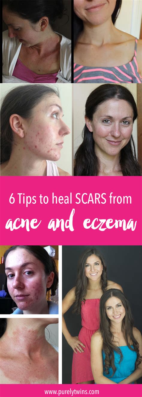 How To Heal Scars From Acne And Eczema Our 6 Tips To Get Glowing Skin