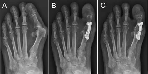 Risk Factors For Nonunion After First Metatarsophalangeal Joint