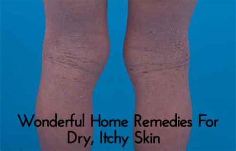 Wonderful Home Remedies For Dry Itchy Skin