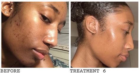 African American Acne Hyperpigmentation Before And After Clear Skin