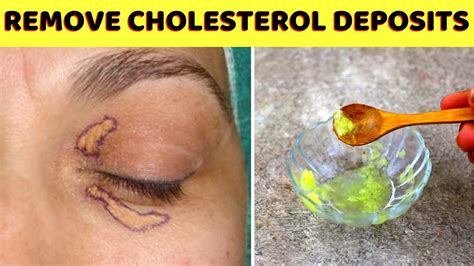 Remove Cholesterol Deposits Xanthelasma Around Eyes Naturally At Home