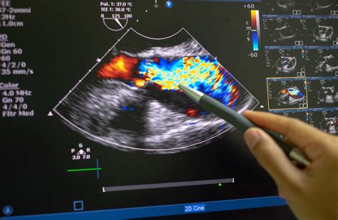 Echocardiography Ultrasound Parker University Parker University