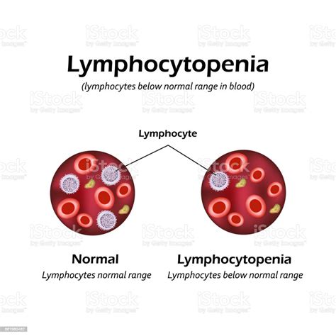 Lymphocytes Below The Normal Range In The Blood Lymphocytopenia Vector