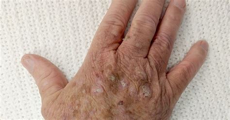 Actinic Keratosis Ak Referred As Solar Keratosis Is A Scaly And