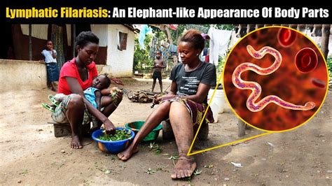 Elephantiasis Or Lymphatic Filariasis An Elephant Like Condition That Afflicts Millions