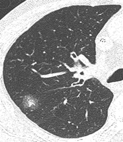 Investigation And Management Of The Solitary Pulmonary Nodule Rcp