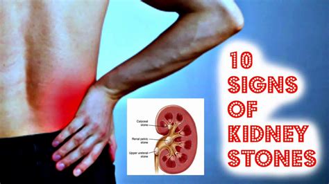 This feeling often moves to the lower abdomen or groin. 10 Signs of Kidney Stones - YouTube