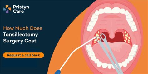 Tonsillectomy Surgery Cost In Kochi Pristyn Care