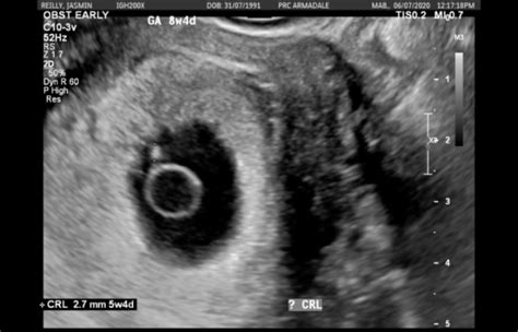 Early Pregnancy 3 Week Ultrasound Pictures Canvas Puke