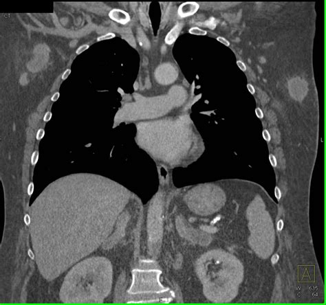 Axillary Nodes Subcutaneous Nodules And Adrenal Metastases In A