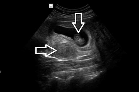An Early Intrauterine Pregnancy Gestational Sac And Embryo Vertical