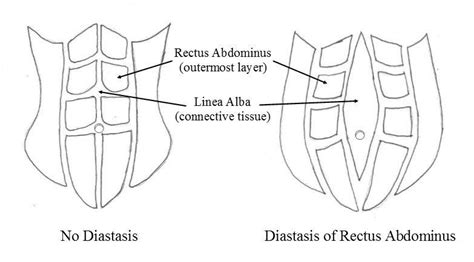 Diastasis Recti Prevention And Treatment