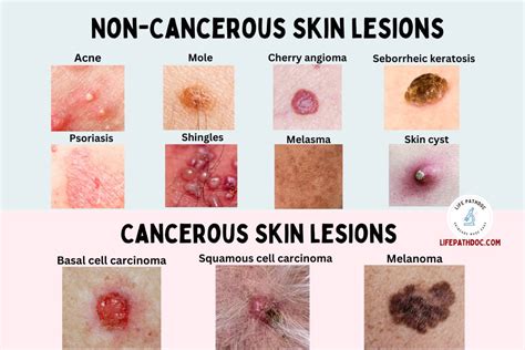 Types Of Skin Lesions Diagnosis Causes Symptoms And Treatment Porn Sex Picture