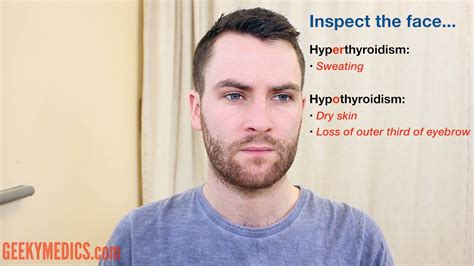 Hypothyroidism Before And After Face