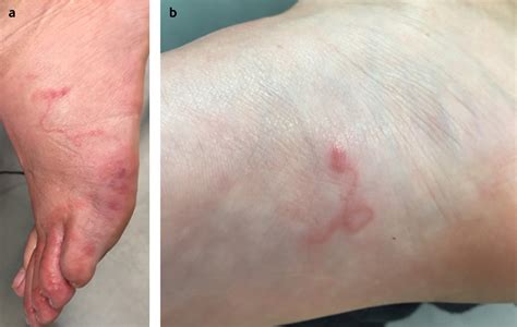 Multiple Itchy Lesions After Recent Travel The Bmj