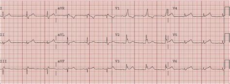 Dr Smiths Ecg Blog Right Bundle Branch Block Rbbb With