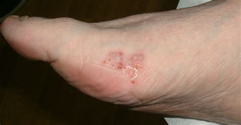 Fungal Skin Podiatry South Belfast Date