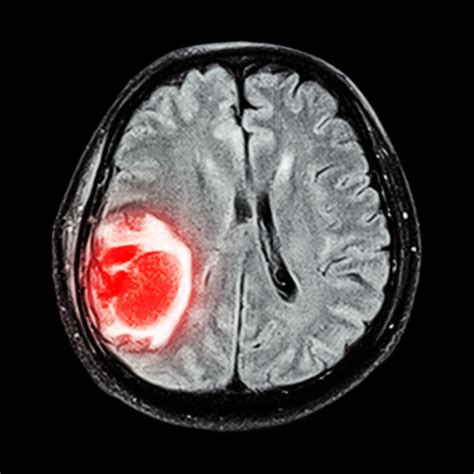 Brain Tumor Symptoms Not Just In Your Head University Health News